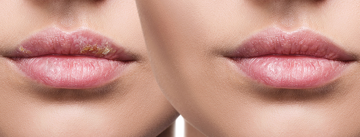 Herpes Simplex on lips