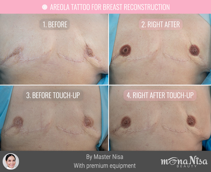 ภาพก่อน-หลังทำทันที และหลังเติมสีการสักหัวนม เต้านม ผู้ป่วยมะเร็งเต้านม