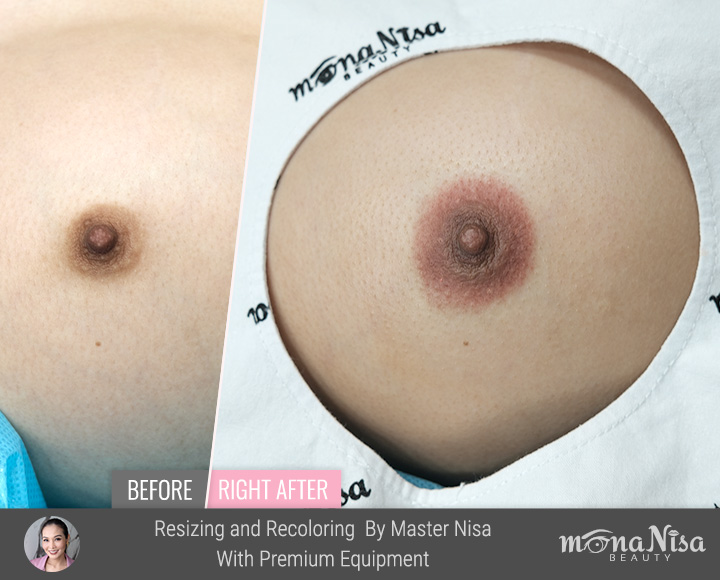 ภาพก่อน-หลังทำทันที และหลังเติมสีการสักขยายขนาดเต้านม จากเล็กไปใหญ่